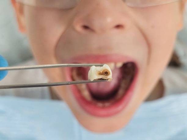 Best Emergency Treatment for Dental Infections or Abscesses in Riverside, OH